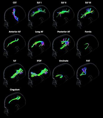 White matter tracts contribute selectively to cognitive functioning in patients with glioma